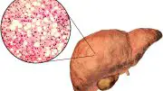 Fatty Liver Illustration and Micrograph