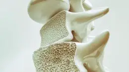 Osteoporosis in Spine